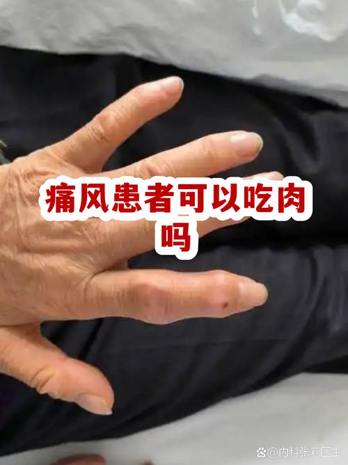 痛风急性期能吃肉吗