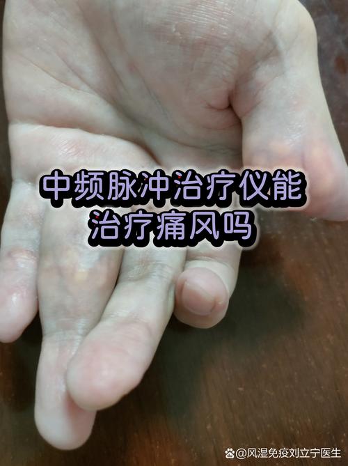 痛风关节疼用理疗仪