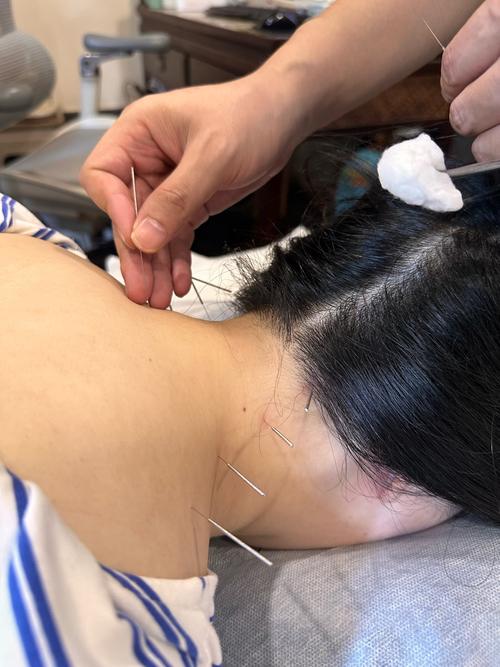 合肥哪里有针灸减肥