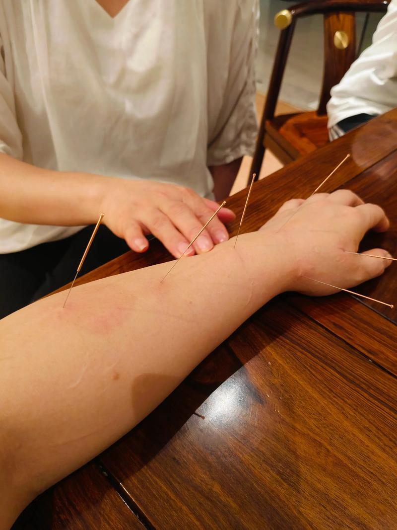 合肥哪里有针灸减肥