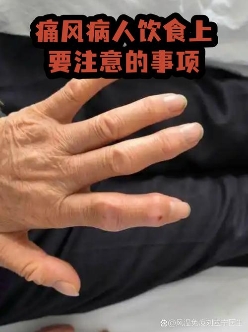 痛风病人能吃百页吗
