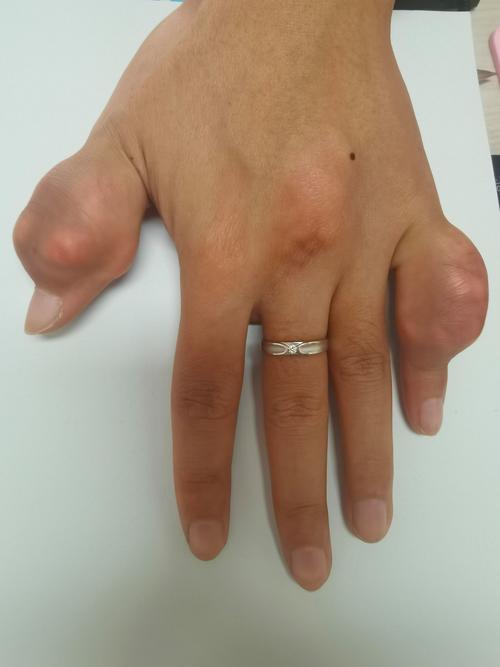 痛风石按下去会痛吗