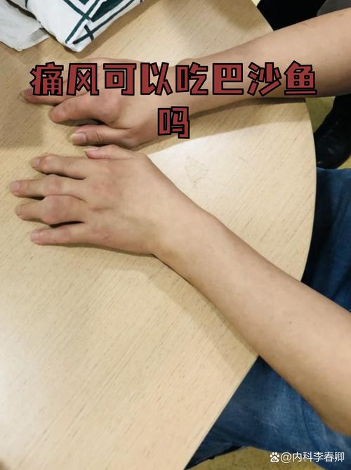 痛风可以吃鱼子酱吗