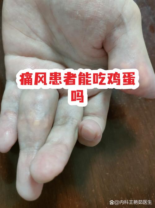 痛风不能吃椰花菜吗