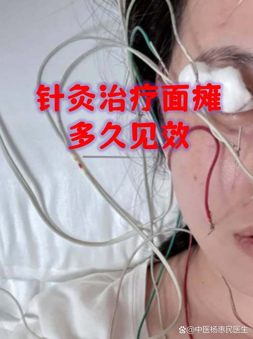 面瘫针灸完面部跳动
