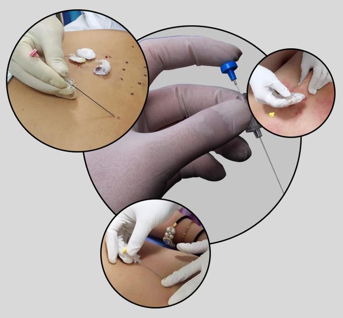 什么是平行针法针灸