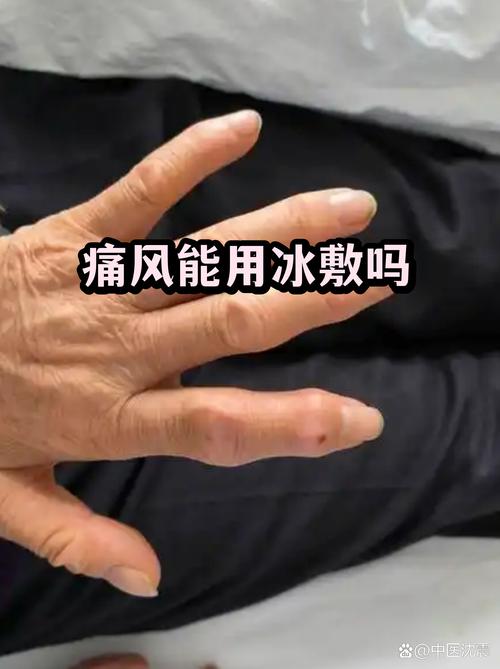 痛风可以用热风吹吗