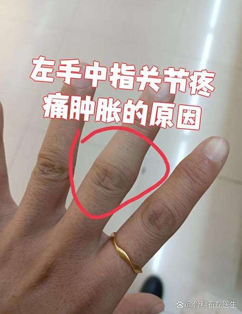 痛风手指关节会疼吗