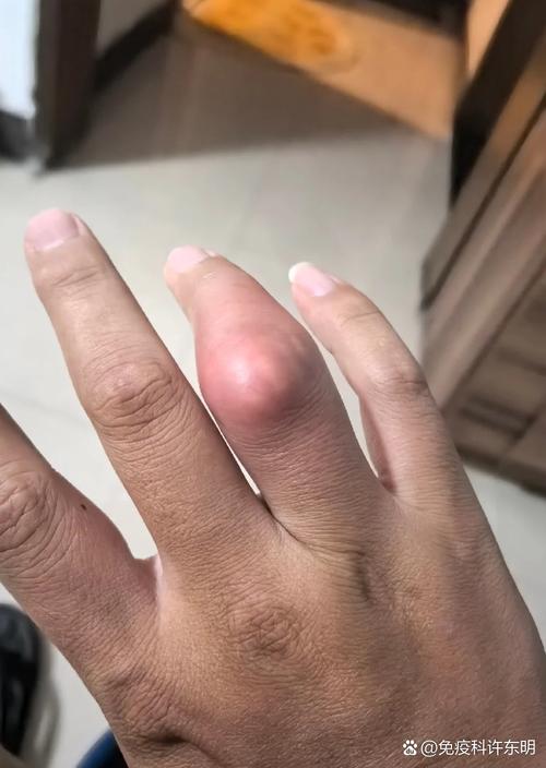痛风手指关节会疼吗