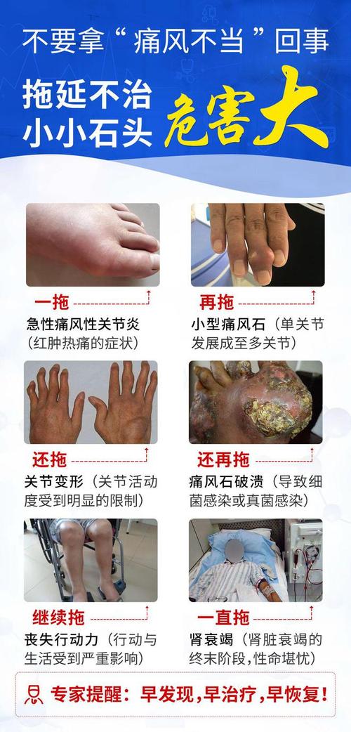 痛风病的症状及治疗