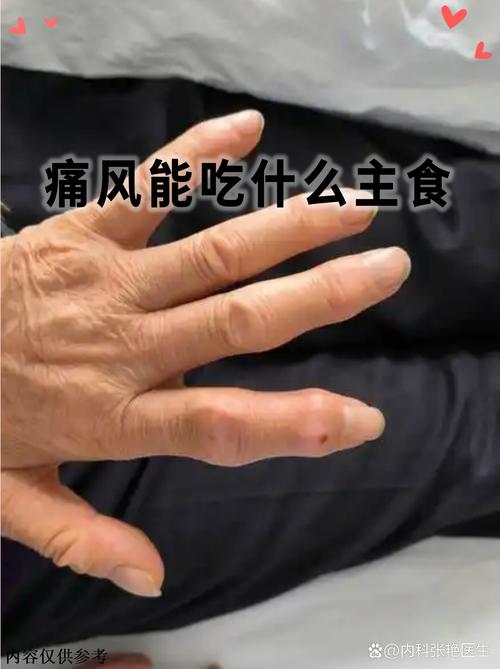 痛风能吃转移因子吗