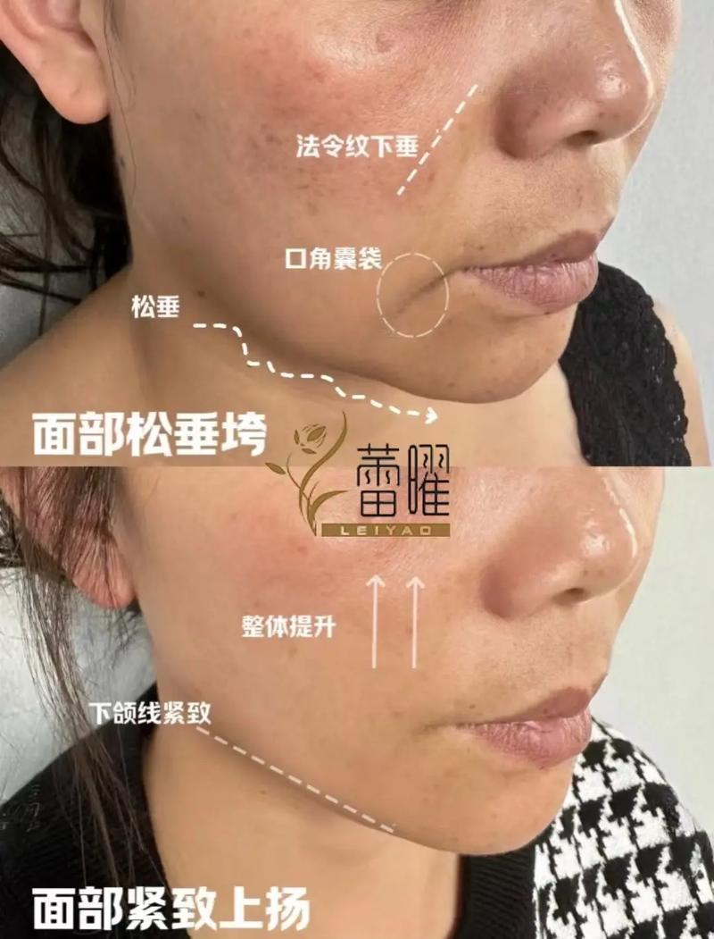 面部针灸提升副作用