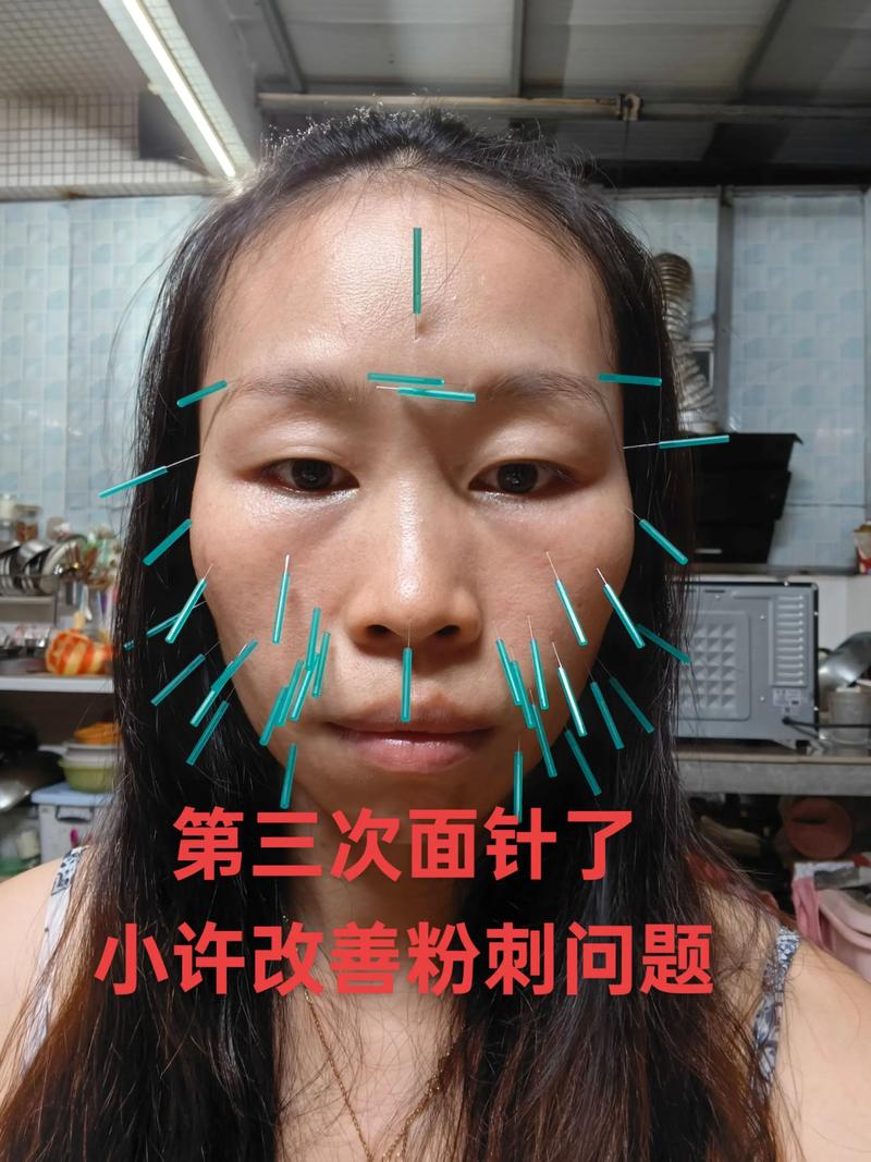 面部针灸提升副作用