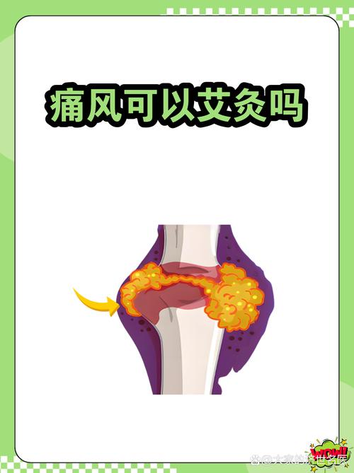 痛风发作时能艾灸吗