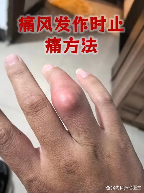 痛风多长时间会死亡