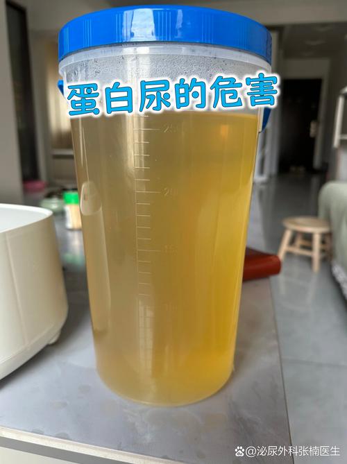 痛风会引起蛋白尿吗