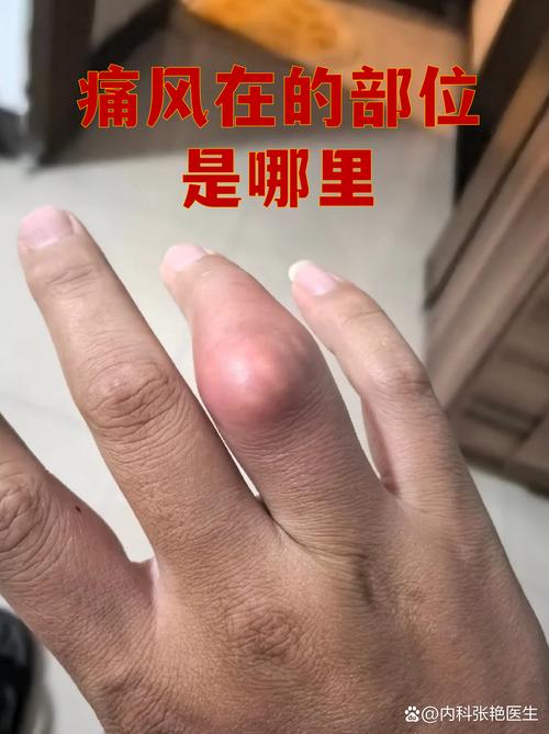 吹风机吹痛风疼痛处