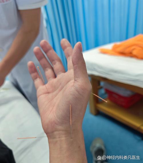 手腕疼痛的针灸方法