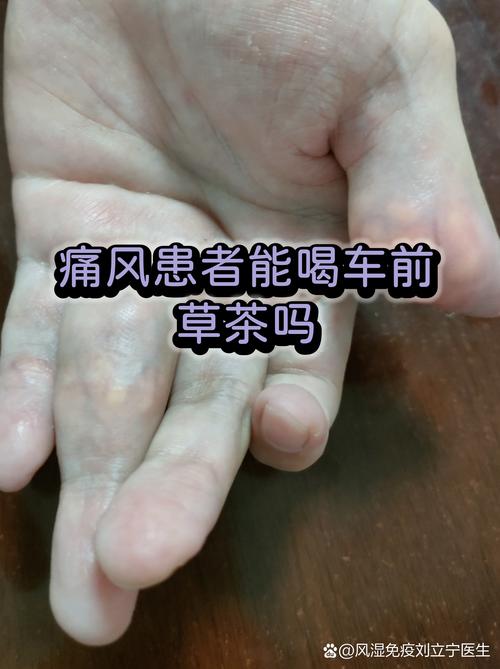 喝糖水会引发痛风吗