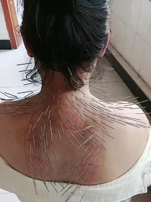 针灸后全身发冷难受
