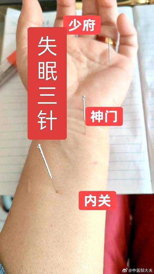 特发性震颤针灸穴位