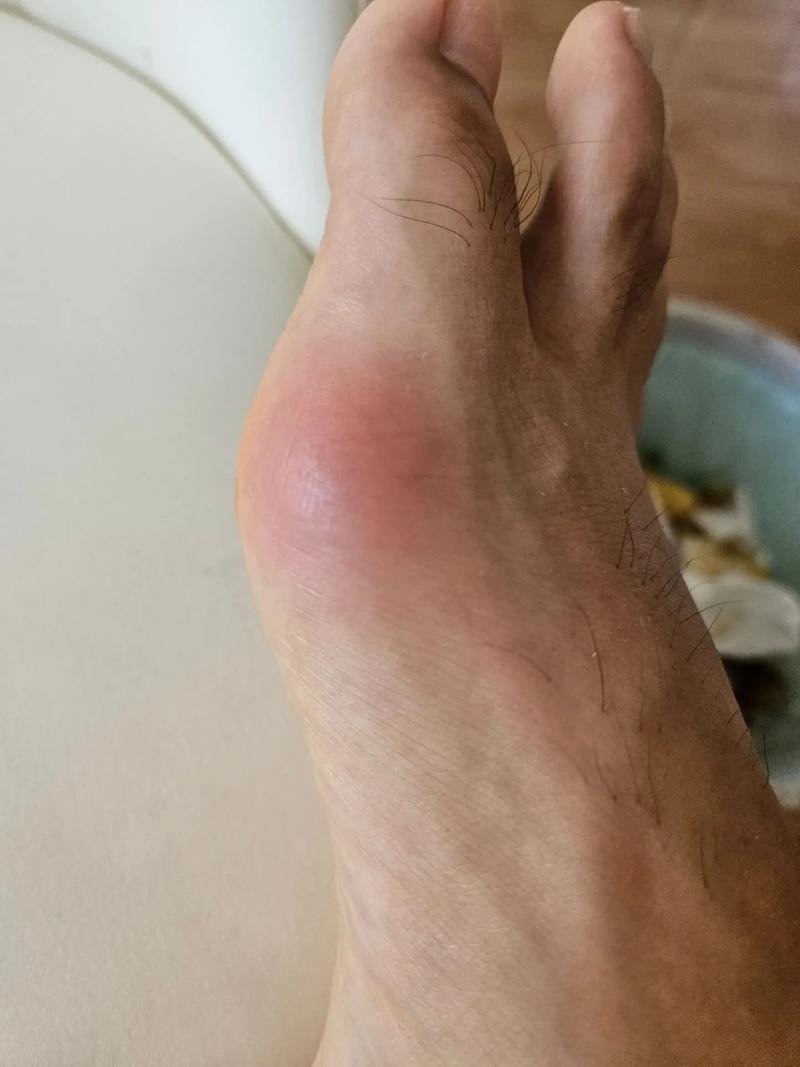 痛风一个星期还没好