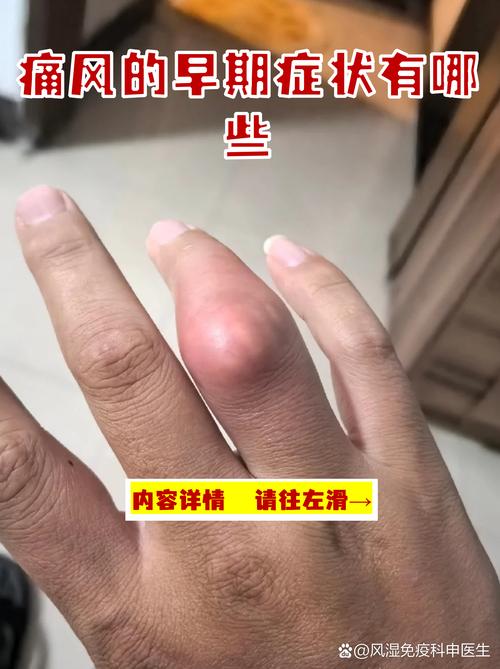 痛风一个星期还没好