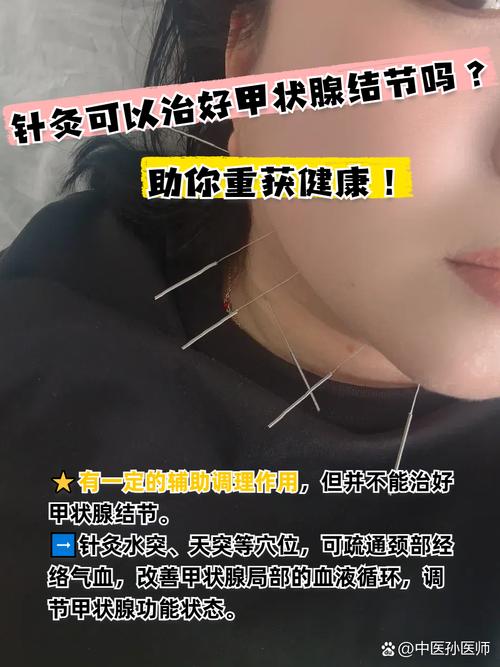 甲状腺功能减退针灸