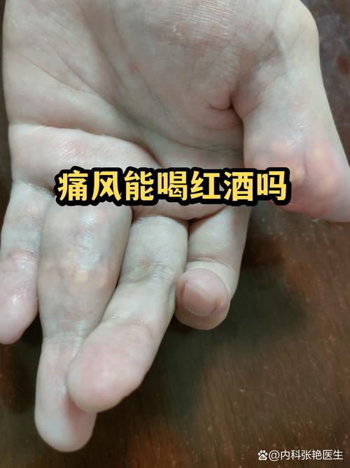 痛风可以吃葡萄酒吗