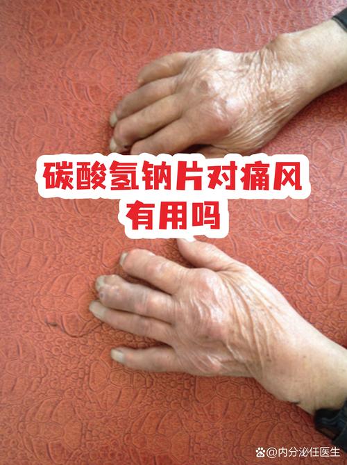 痛风发作能吃碱片吗