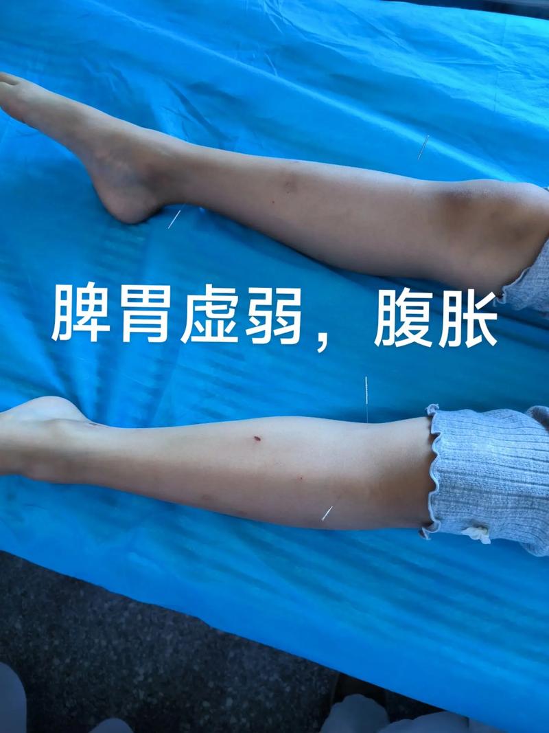 脾胃虚寒针灸能好吗