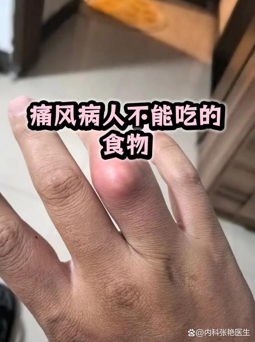 痛风病人能不能游泳