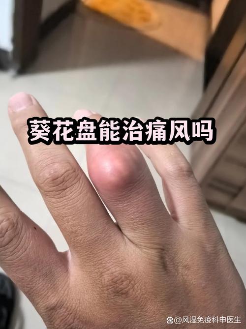 酸立通可以治痛风吗