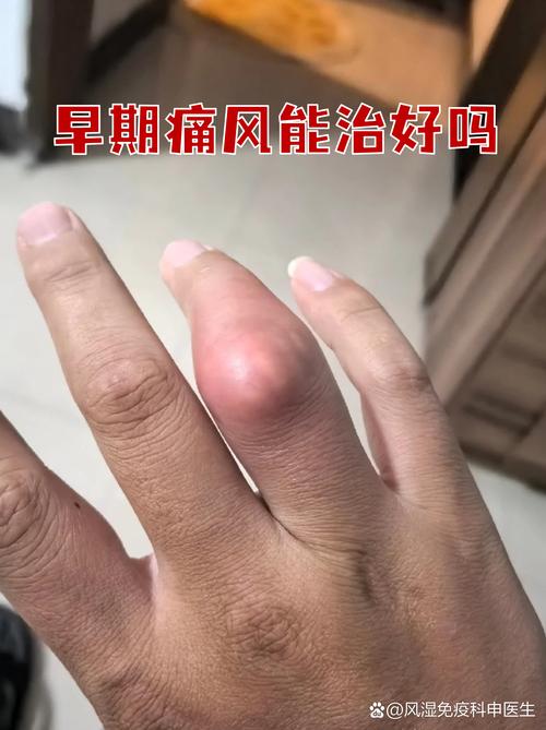 痛风一般多久能好啊