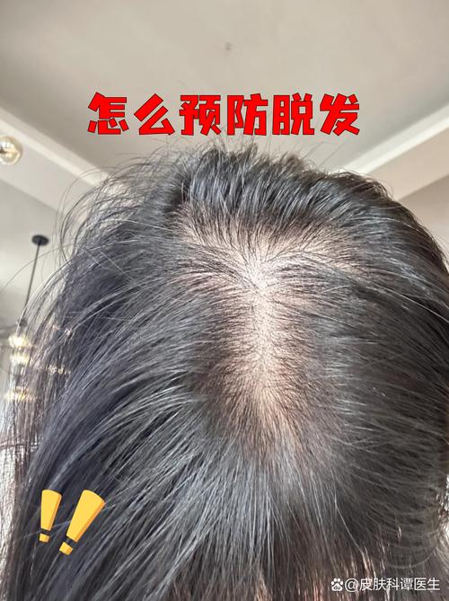 哈尔滨治脱发青年安全
