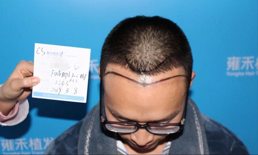 哈尔滨治脱发青年安全