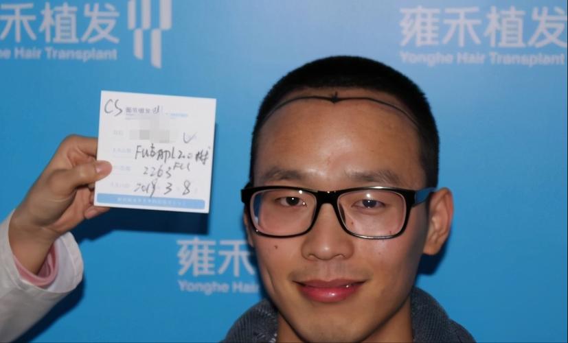 哈尔滨治脱发青年安全