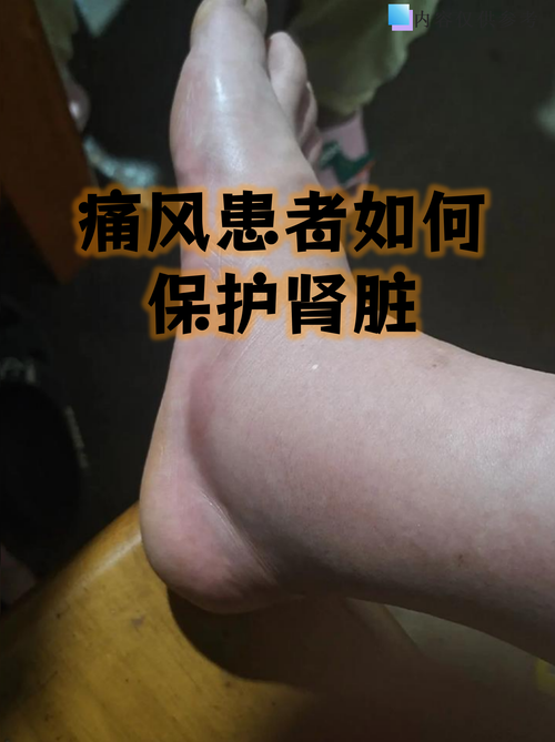 痛风病人肾有问题吗