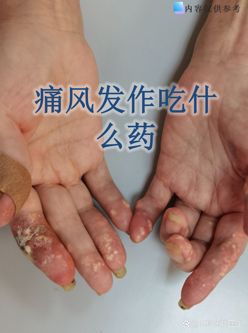 痛风没有药该怎么办