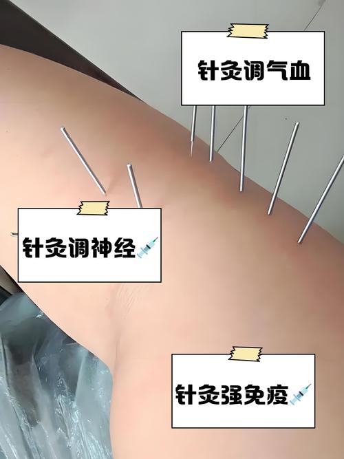 郑州中医针灸哪里好
