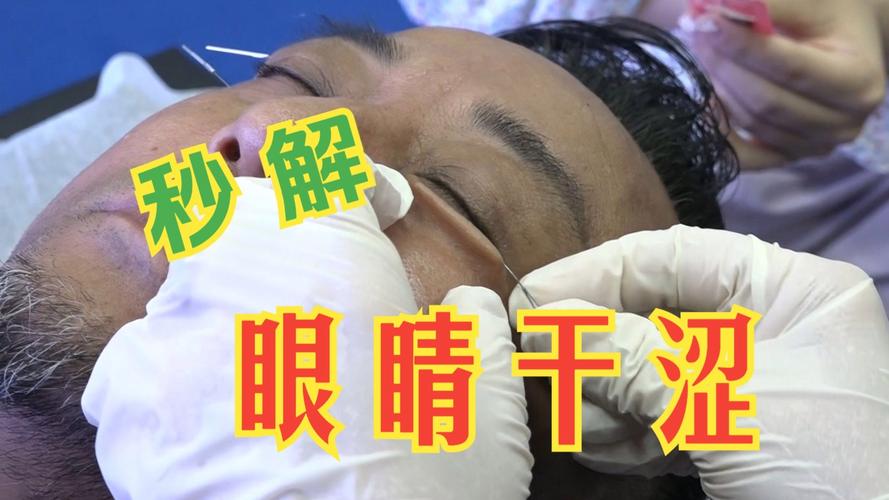 针灸能治好干眼症吗