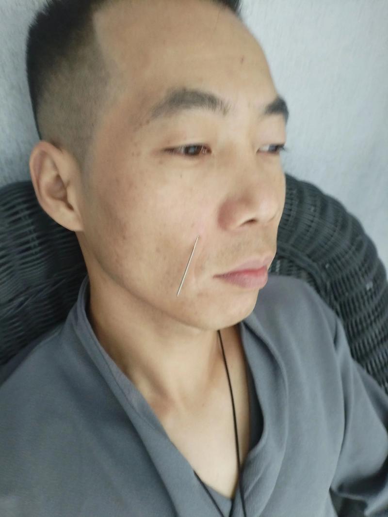 人中针灸治什么作用
