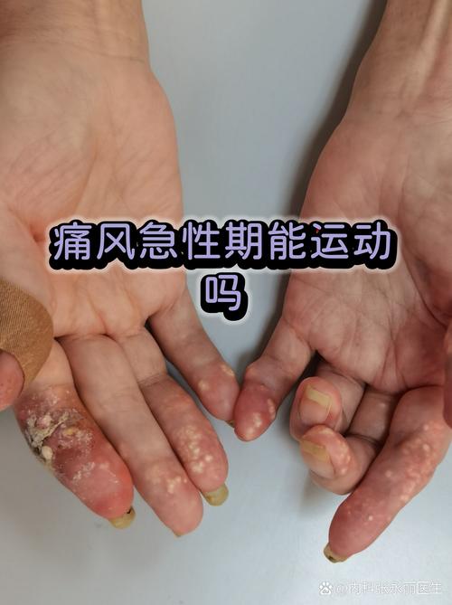 痛风发病时能运动吗