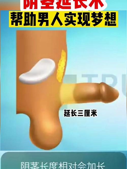 阴茎延长手术是否安全