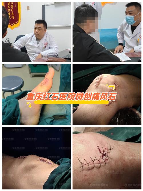 重庆痛风医院排行榜