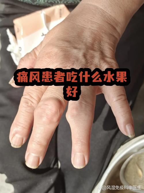 痛风最好吃什么水果