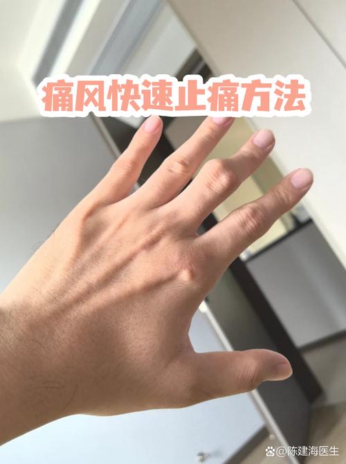 青岛人如何治疗痛风