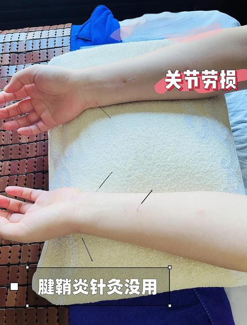 腱鞘炎 针灸 上海