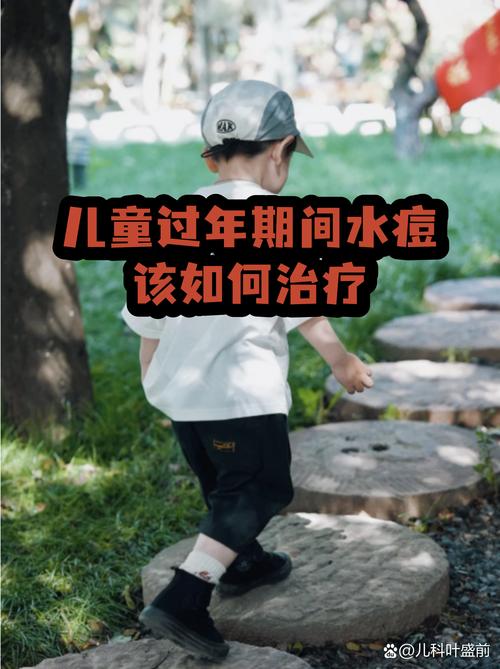 水痘可以针灸治疗吗