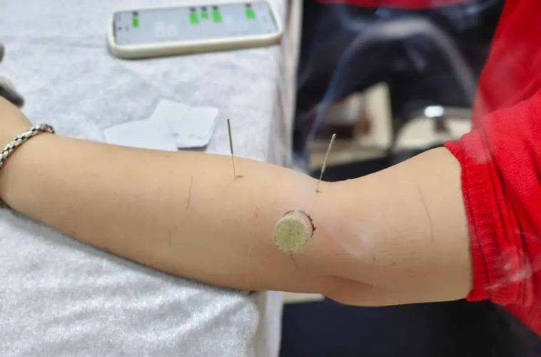 温州哪个医院针灸好